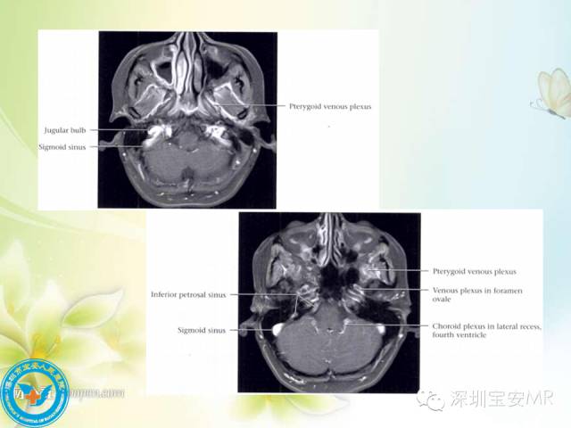 【PPT】颅内静脉系统影像CT,MRI及DSA解剖