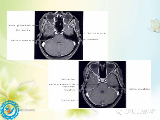 【PPT】颅内静脉系统影像CT,MRI及DSA解剖