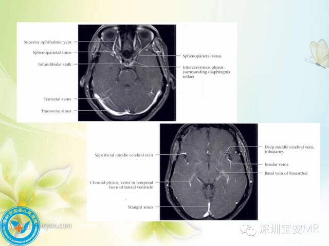 【PPT】颅内静脉系统影像CT,MRI及DSA解剖