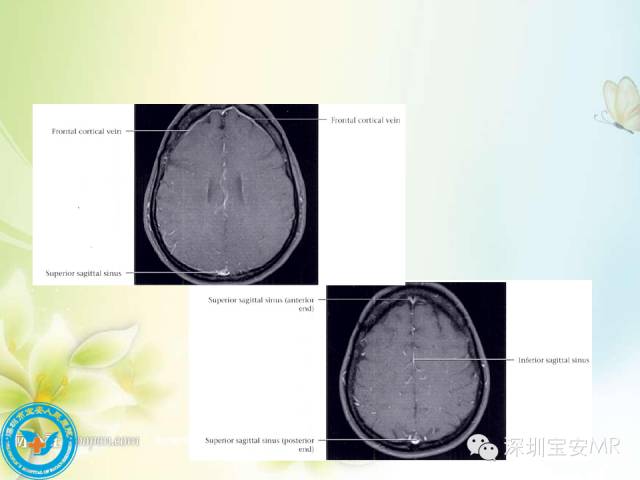 【PPT】颅内静脉系统影像CT,MRI及DSA解剖