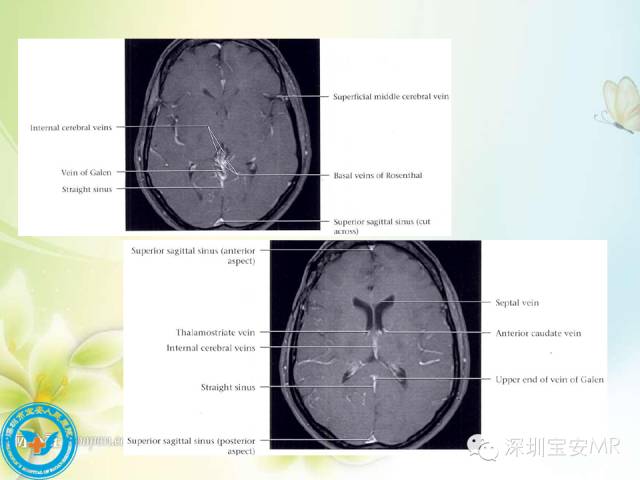 【PPT】颅内静脉系统影像CT,MRI及DSA解剖