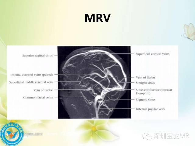 【PPT】颅内静脉系统影像CT,MRI及DSA解剖