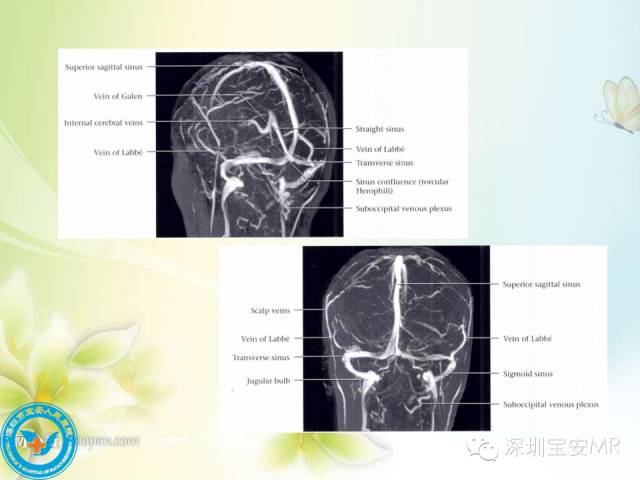 【PPT】颅内静脉系统影像CT,MRI及DSA解剖