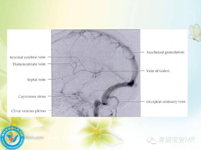 【PPT】颅内静脉系统影像CT,MRI及DSA解剖