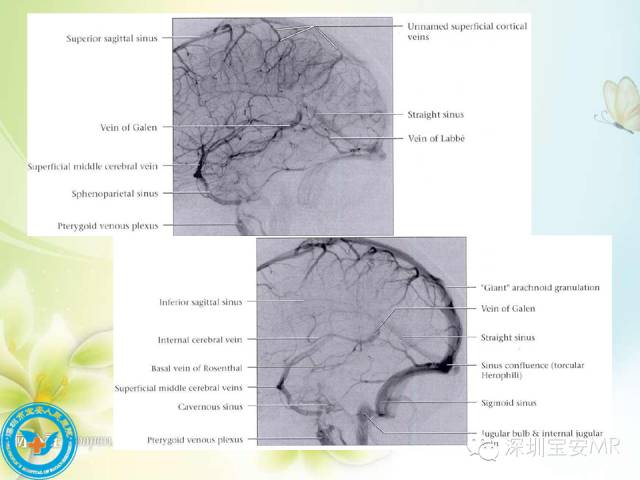 【PPT】颅内静脉系统影像CT,MRI及DSA解剖