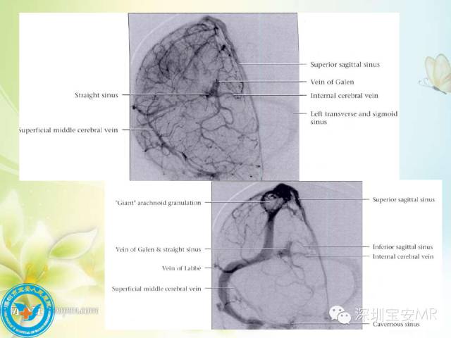 【PPT】颅内静脉系统影像CT,MRI及DSA解剖