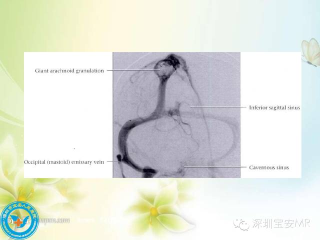 【PPT】颅内静脉系统影像CT,MRI及DSA解剖