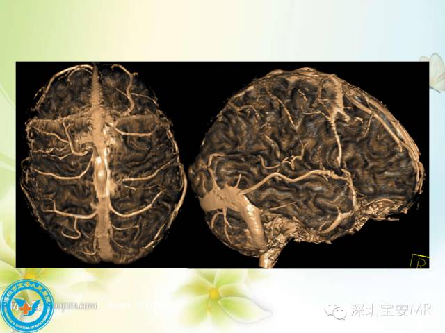 【PPT】颅内静脉系统影像CT,MRI及DSA解剖