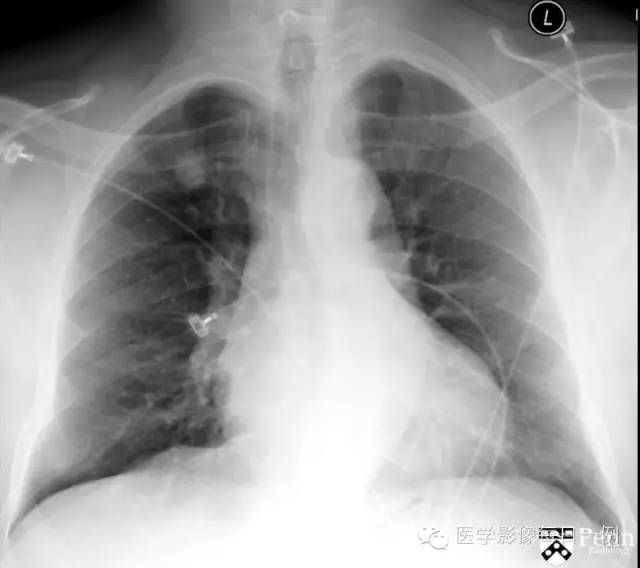 【病例】肺错构瘤1例CT影像表现 【病例】肺错构瘤1例CT影像表现