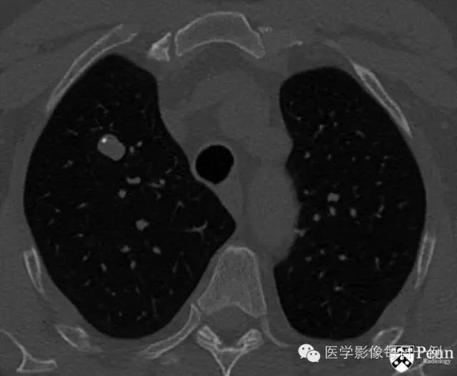 【病例】肺错构瘤1例CT影像表现 【病例】肺错构瘤1例CT影像表现