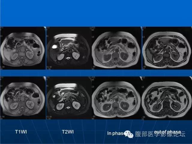 【病例】右肾平滑肌瘤1例CT影像表现 【病例】右肾平滑肌瘤1例CT影像表现