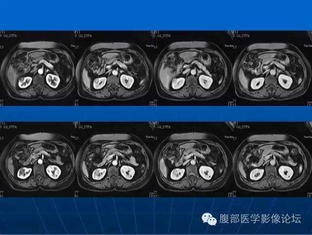 【病例】右肾平滑肌瘤1例CT影像表现 【病例】右肾平滑肌瘤1例CT影像表现