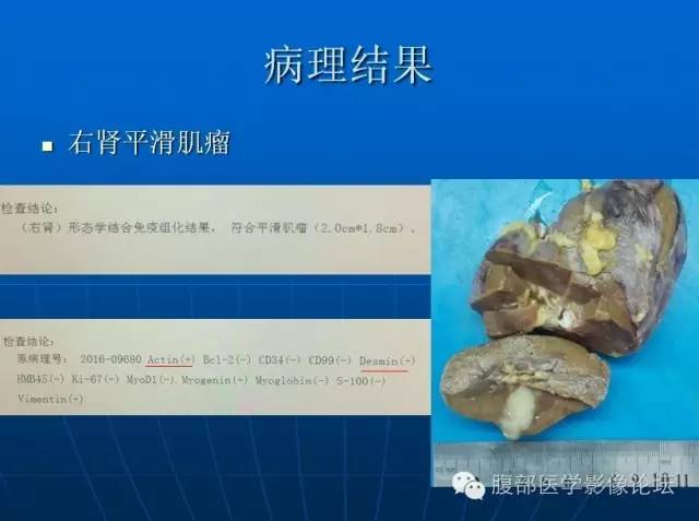 【病例】右肾平滑肌瘤1例CT影像表现 【病例】右肾平滑肌瘤1例CT影像表现