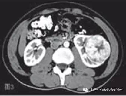 【病例】右肾平滑肌瘤1例CT影像表现 【病例】右肾平滑肌瘤1例CT影像表现