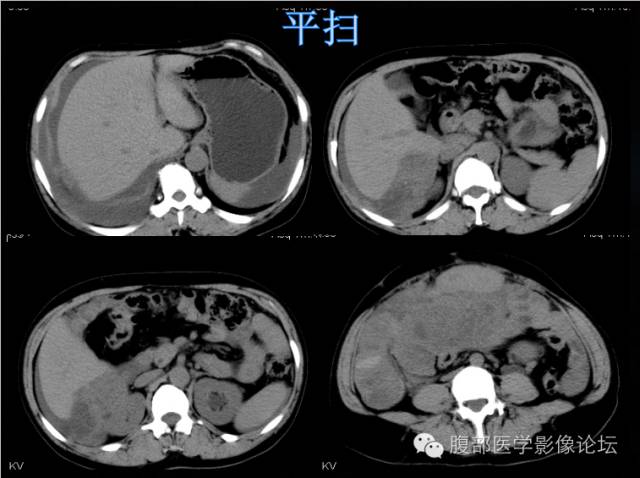 【病例】卵巢颗粒细胞瘤1例CT影像表现