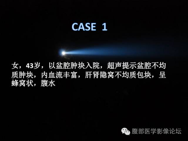 【病例】卵巢颗粒细胞瘤1例CT影像表现