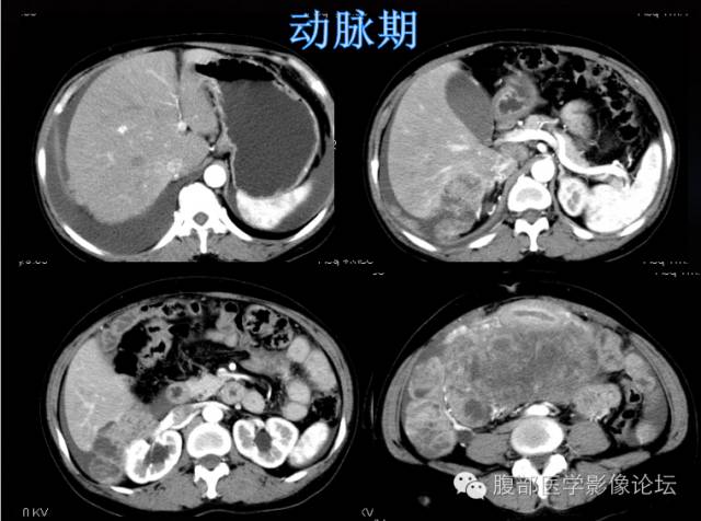 【病例】卵巢颗粒细胞瘤1例CT影像表现
