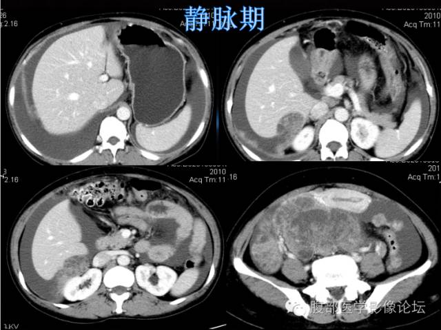 【病例】卵巢颗粒细胞瘤1例CT影像表现