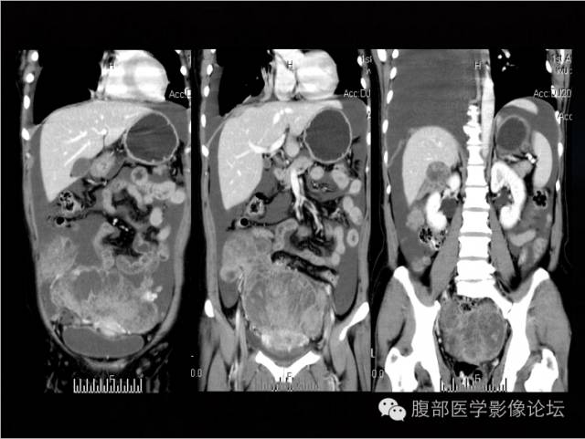 【病例】卵巢颗粒细胞瘤1例CT影像表现