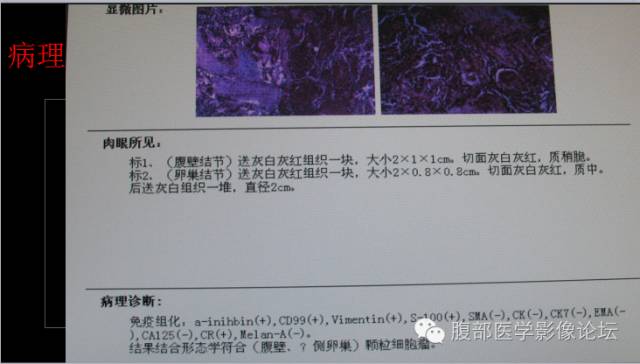 【病例】卵巢颗粒细胞瘤1例CT影像表现