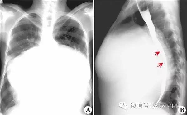 心包积液与心肌病在X线上如何鉴别？