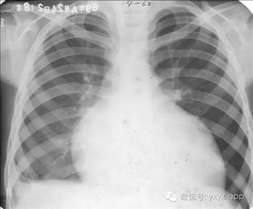 心包积液与心肌病在X线上如何鉴别？