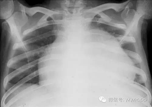 心包积液与心肌病在X线上如何鉴别？