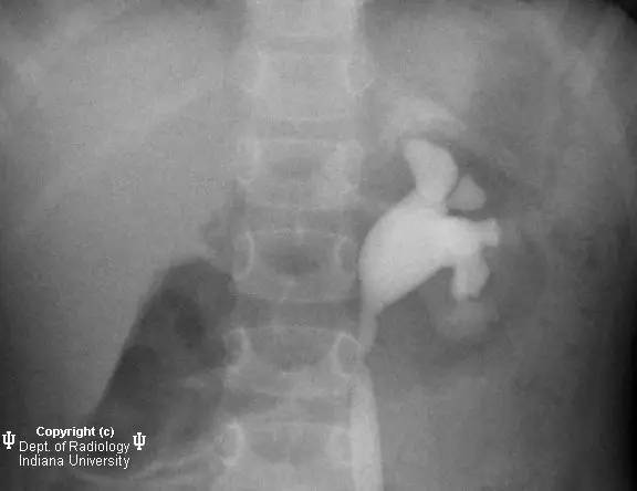 【病例】膀胱输尿管反流1例X线影像表现 【病例】膀胱输尿管反流1例X线影像表现