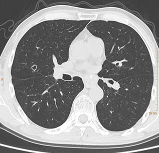 肺转移瘤的13个不典型表现 肺转移瘤的13个不典型表现
