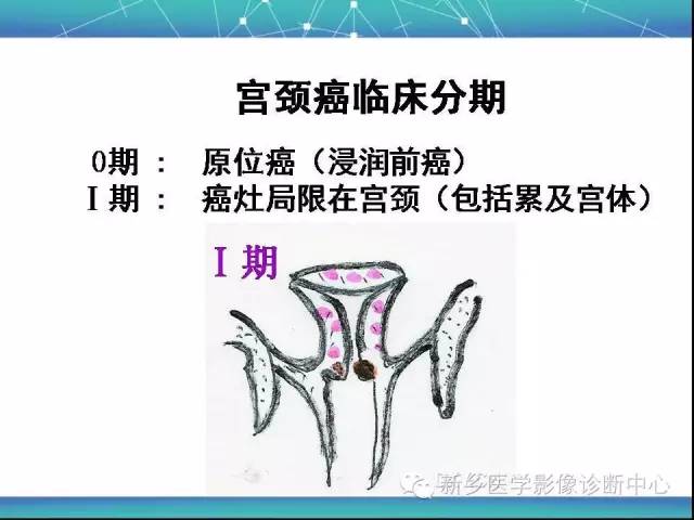 【PPT】宫颈癌临床分期