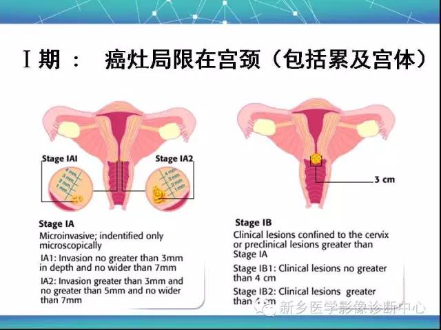 【PPT】宫颈癌临床分期
