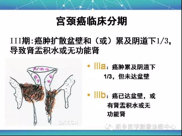 【PPT】宫颈癌临床分期
