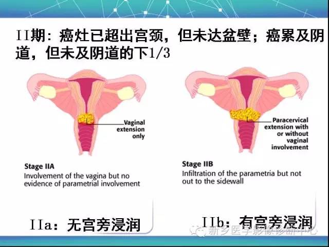 【PPT】宫颈癌临床分期