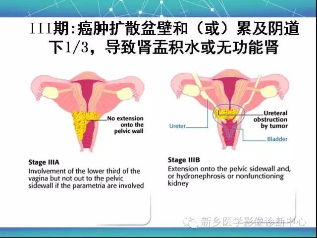 【PPT】宫颈癌临床分期
