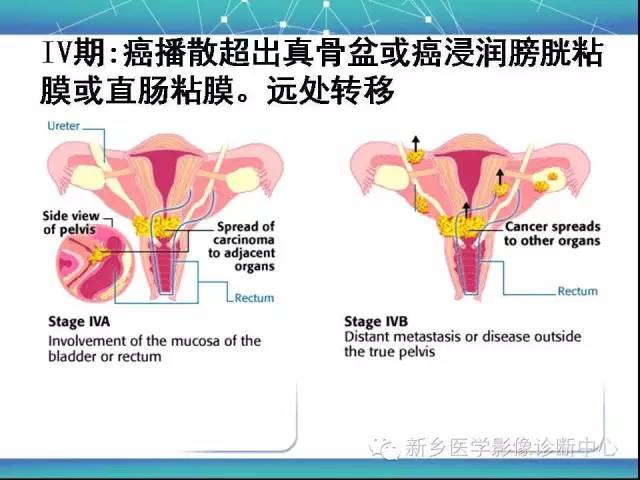 【PPT】宫颈癌临床分期
