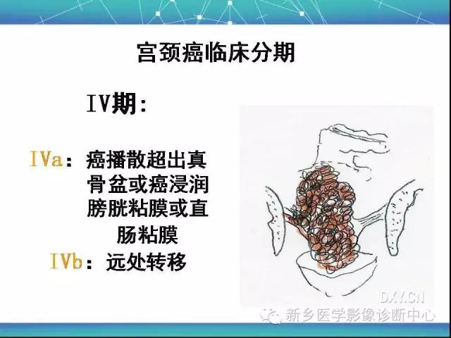 【PPT】宫颈癌临床分期