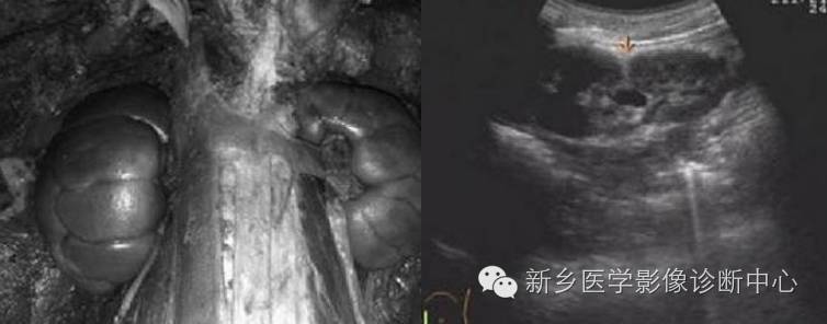 胎儿分叶状肾脏 胎儿分叶状肾脏