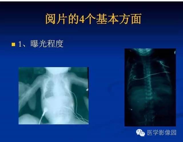 【PPT】新生儿肺部疾病影像学进展