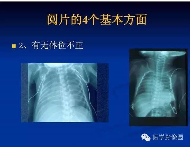 【PPT】新生儿肺部疾病影像学进展