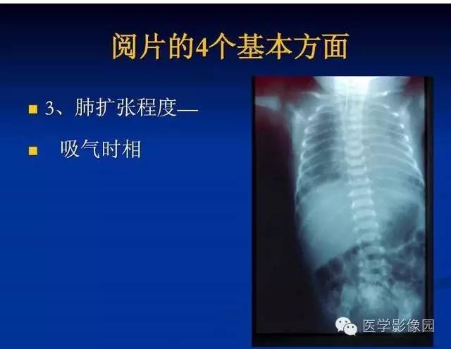【PPT】新生儿肺部疾病影像学进展