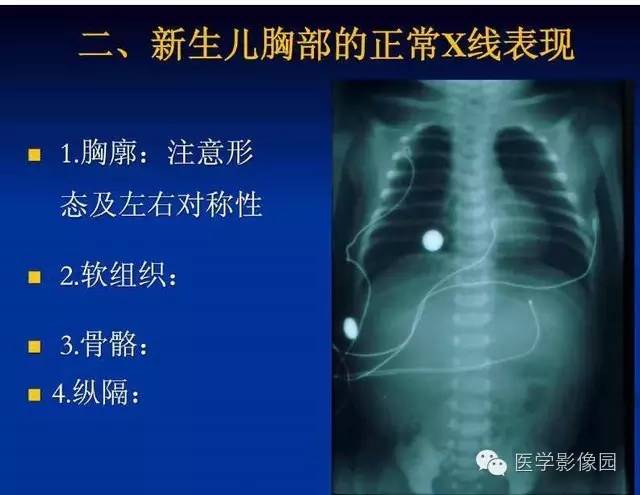 【PPT】新生儿肺部疾病影像学进展