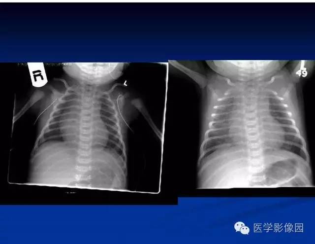 【PPT】新生儿肺部疾病影像学进展