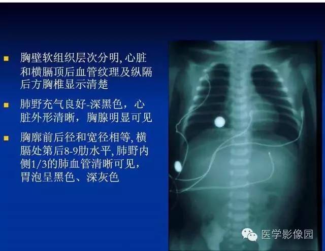 【PPT】新生儿肺部疾病影像学进展