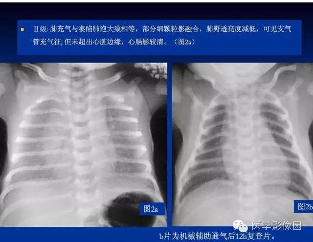 【PPT】新生儿肺部疾病影像学进展