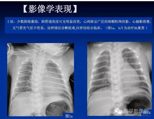 【PPT】新生儿肺部疾病影像学进展