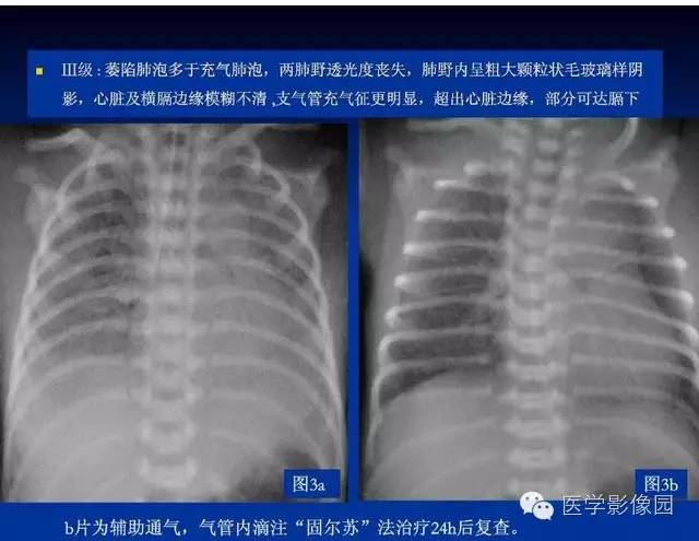 【PPT】新生儿肺部疾病影像学进展