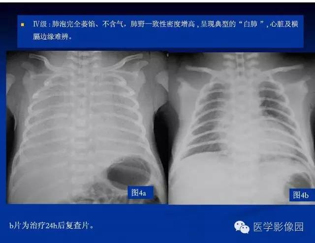 【PPT】新生儿肺部疾病影像学进展
