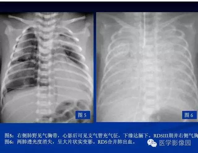 【PPT】新生儿肺部疾病影像学进展