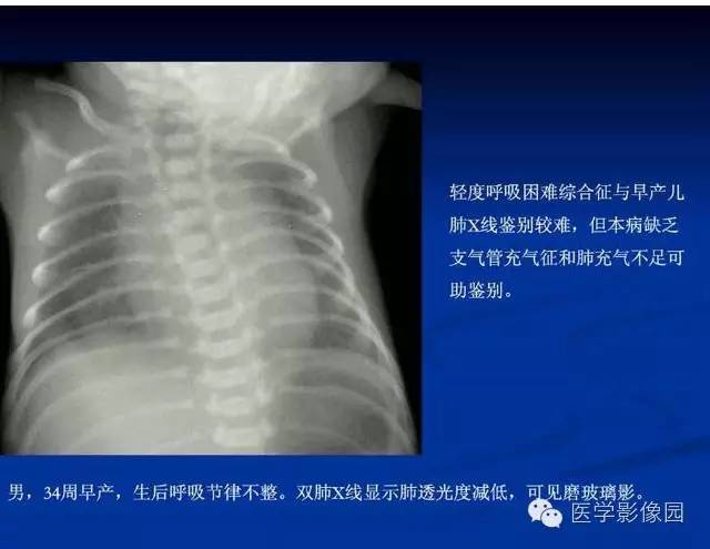 【PPT】新生儿肺部疾病影像学进展