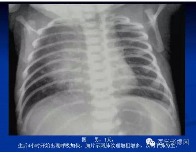 【PPT】新生儿肺部疾病影像学进展